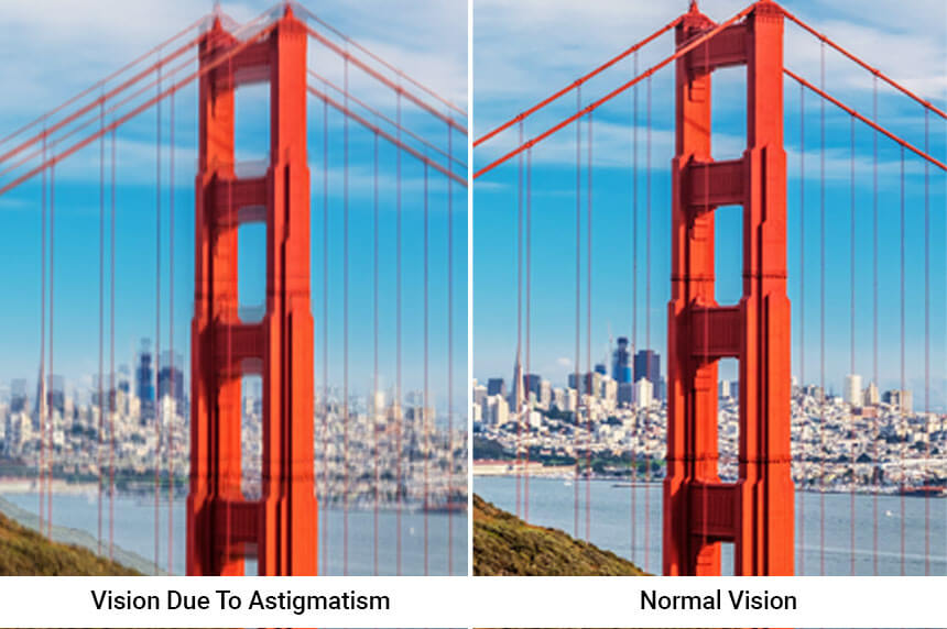 What Is Astigmatism Can LASIK Eye Surgery Correct The Problem 