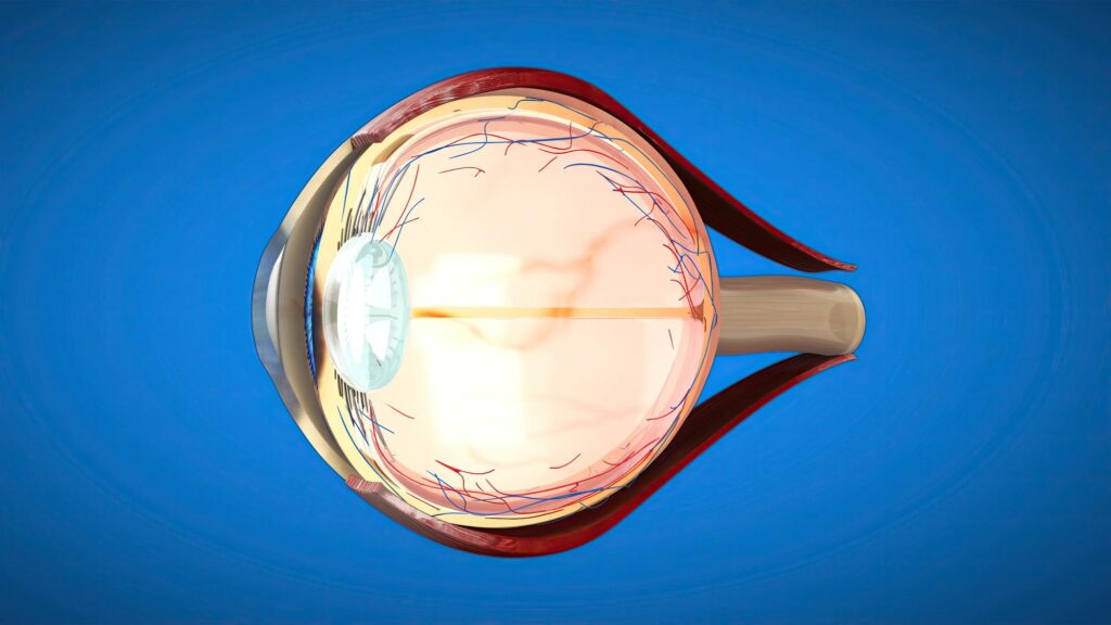 refractive errors of eye