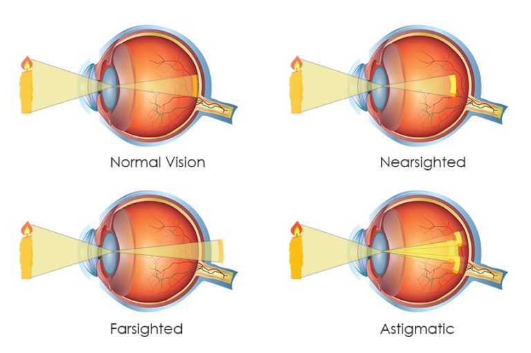 myopia vs hyperopia vs astigmatism