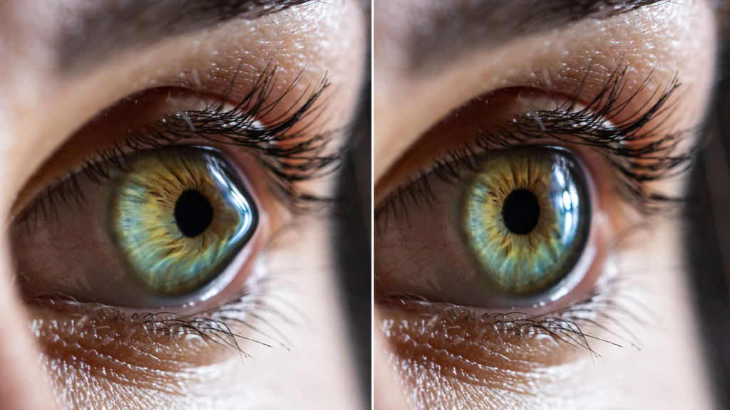 Irregular shape of your eye’s cornea or lens